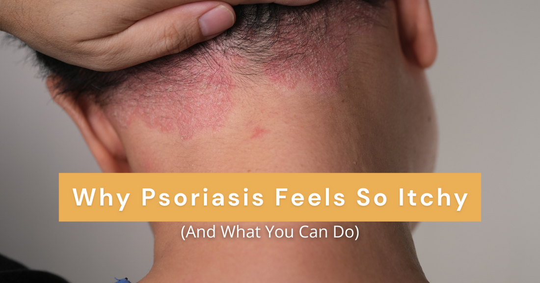Why Psoriasis Feels So Itchy (And What You Can Do)